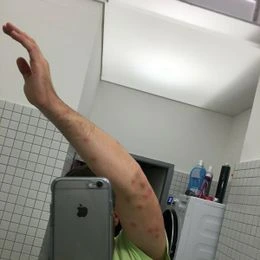 Ruce s více červenými štěnicími kousy v zrcadle.