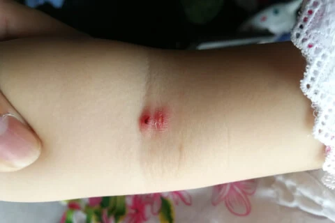 Insect bite on child's arm